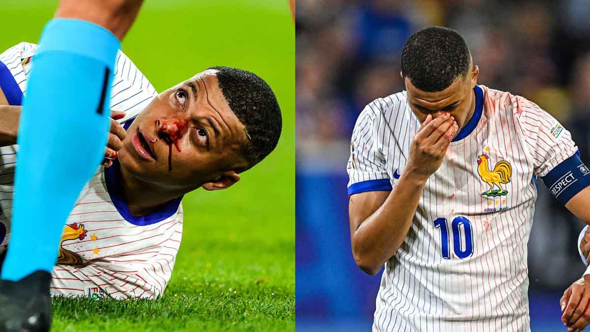 Kylian Mbappe suffered a serious blow to his nose in his first match of the Euro Cup France vs Austria